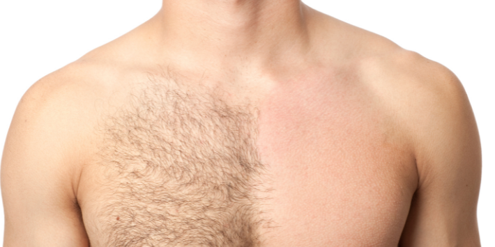 man's chest laser hair removal